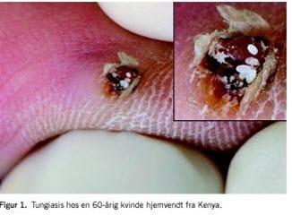 Tungiasis, chigoe flea