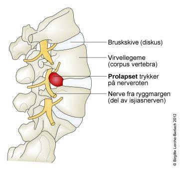 Skiveprolaps Skiveprolaps