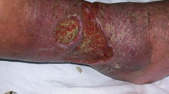 Venous ulcer, leg