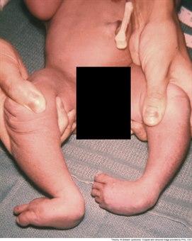 Trisomi 18 Trisomi 18