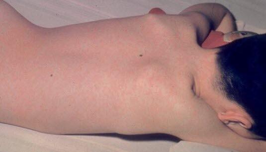 Measles exanthema back after three days
