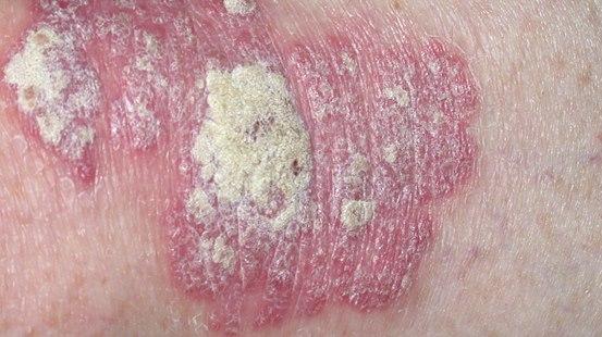 Psoriasis, plakk
