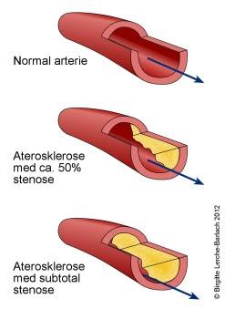 Aterosklerose, lengdesnitt Aterosklerose, lengdesnitt