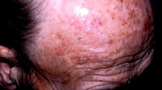 Aktiniske keratoser, multiple