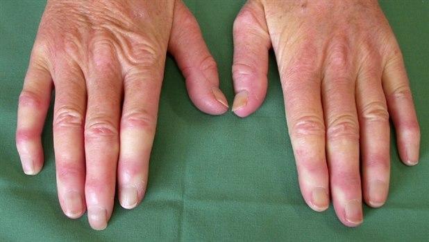 Raynauds fenomen 1280x725