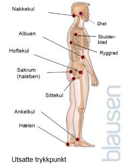 Vanlige lokalisasjoner av trykksår