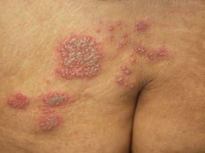 Herpes zoster