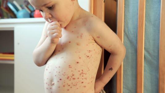 Chickenpox