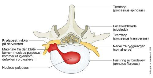 9932-2-484-lumbal-disskusprolaps-tversnit.jpg 9932-2-484-lumbal-disskusprolaps-tversnit.jpg