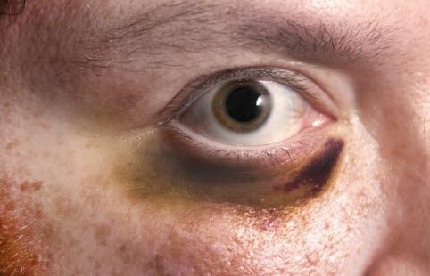 Black eye