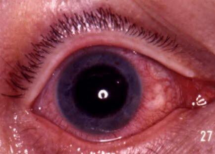Iridocyclitis