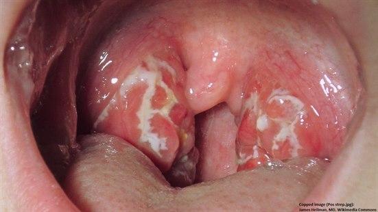 Streptokokk halsinfeksjon