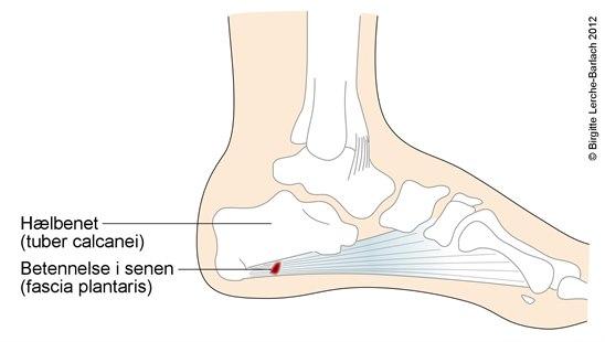 Tendinitis side projection