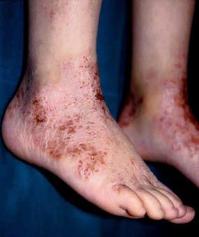 Atopisk eksem på fotrygg