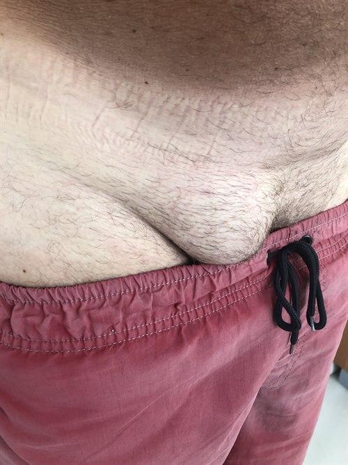 Lyskebrokk Lyskebrokk