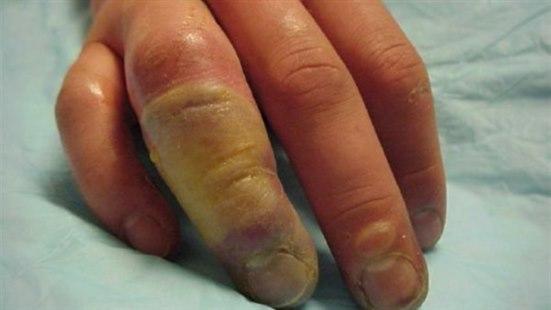 Bildequiz uke 2.jpg Ei hånd med annen grads frostskade som har ført til væskefylte/blodfylte blemmer