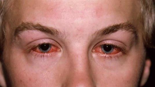 Keratoconjunktivitis