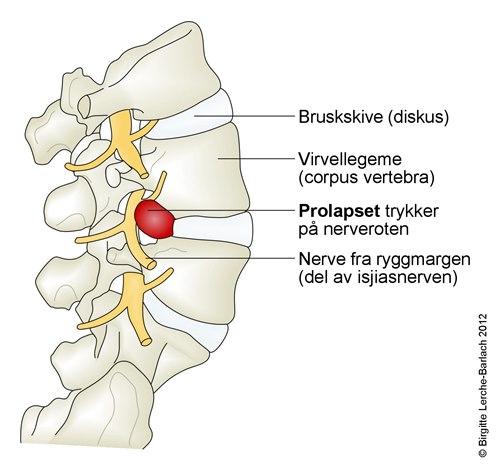 Lumbalt skiveprolaps sett fra siden