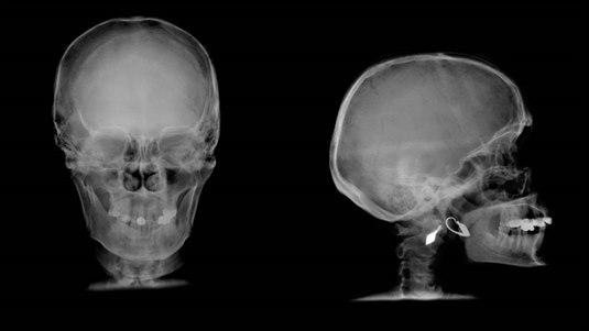 Hodeskade Røntgenbilde av sideprofil og baksiden av en hodeskalle