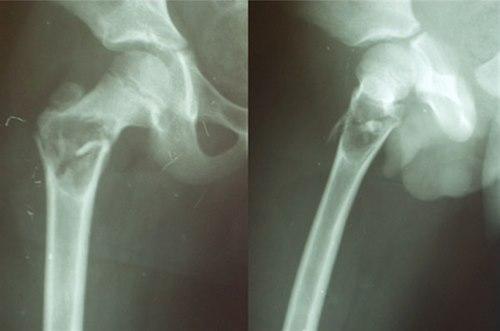 Beincyste i lårbeinet Beincyste i lårbeinet