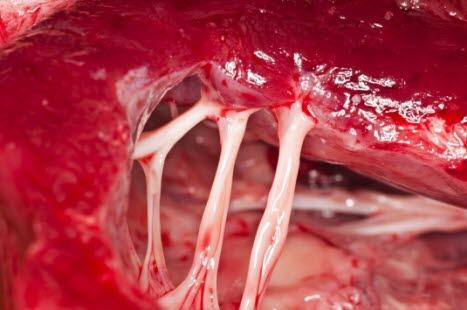 Hjerteklaff med tråder (chordae tendinae)