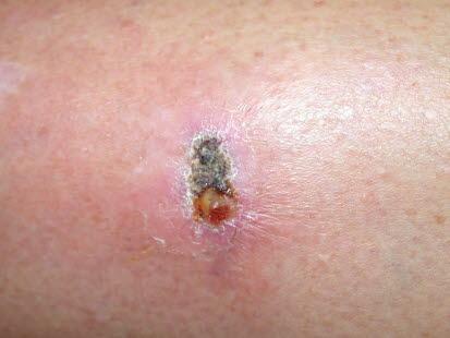 Stikkskade, infisert Fremmedlegeme i huden