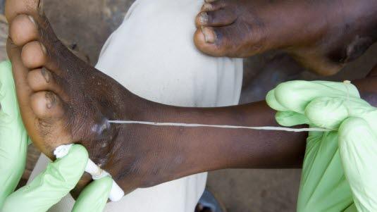 Dracunculis medinensis