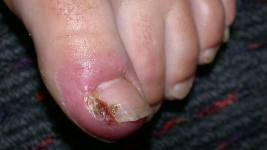 Ingrown toenail