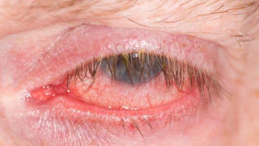 Pink eye, conjunctivitis Rødt og irritabelt øye