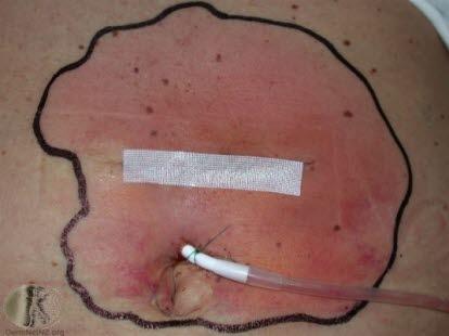 Phlegmon, group A-streptococci