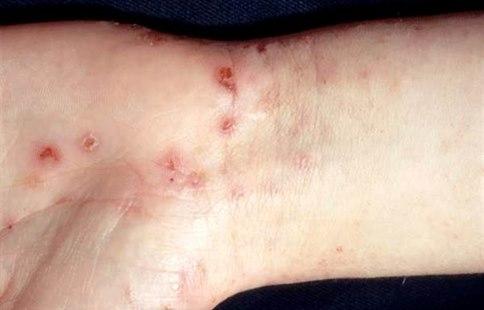 Scabies, skin lesions
