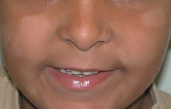 Pityriasis alba Fotoet viser nærbildet av et barns ansikt. Det sees klassiske hypopigmenterte flekker på kinn, hake og ved munnen.