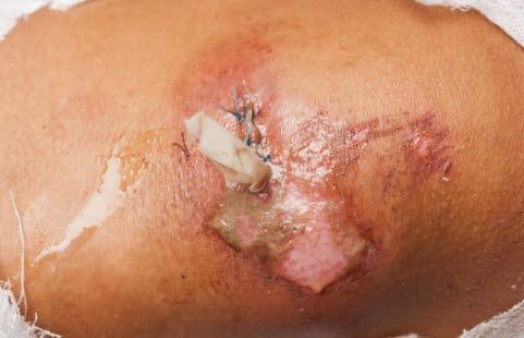 Wound infection