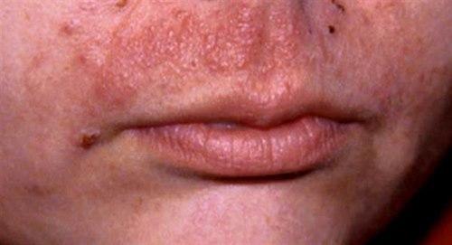 Allergisk kontakteksem Allergisk kontakteksem