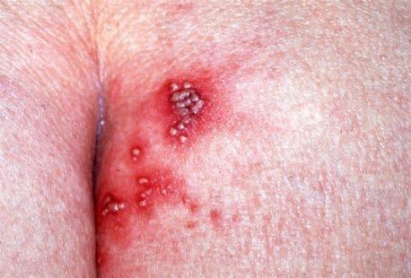 Genital herpes, gluteal