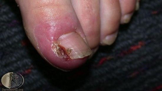Ingrown toenail