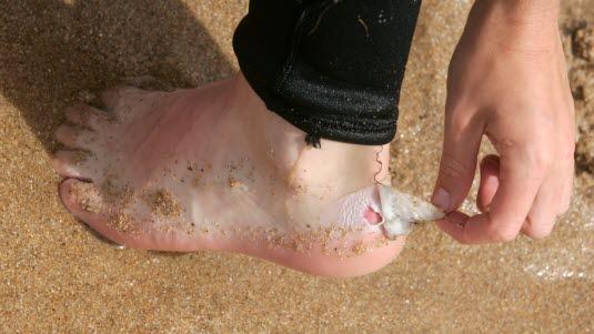 Gnagsår Illustrasjonsfoto av noen som river av et gnagsårplaster som er på hælen. Vi ser en liten del av gnagsåret.