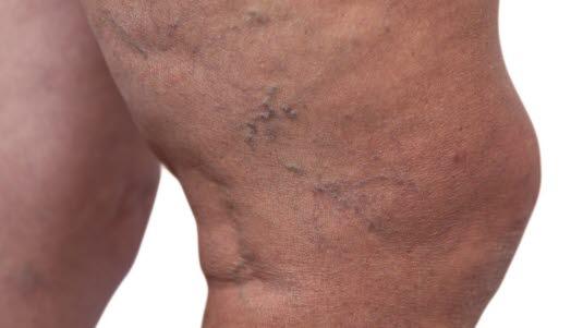 Varicose veins, leg