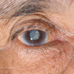 Cataract