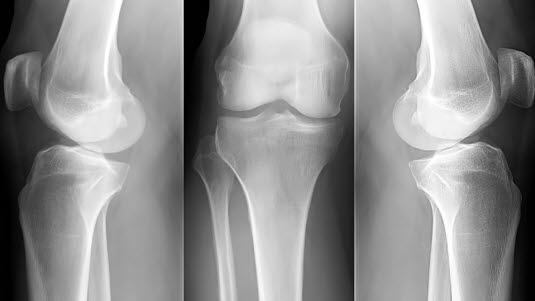X-ray knee joint