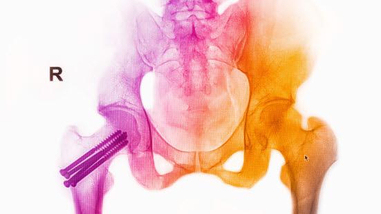 Lårhalsbrudd behandlet med pinner