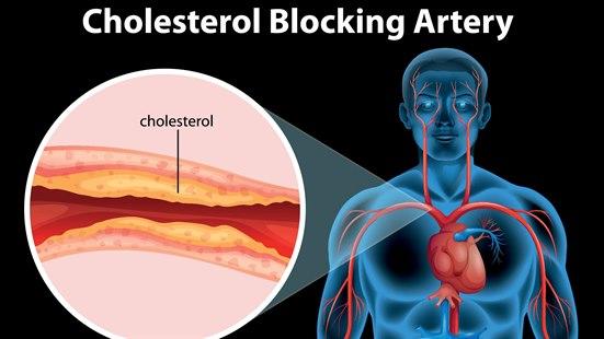 Atherosclerosis