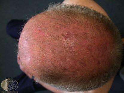 Common male baldness