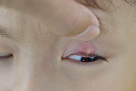 Stye (hordeolum)