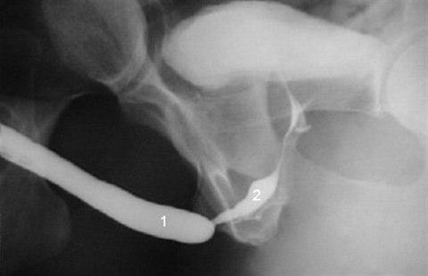 Urethral stricture