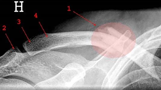 Kragebeinskade Røntgenbilde av kragebeinskade
