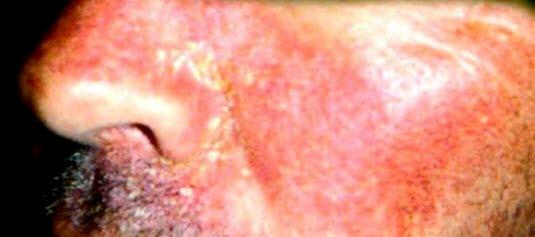 Seborrhoeic dermatitis, eczema, face