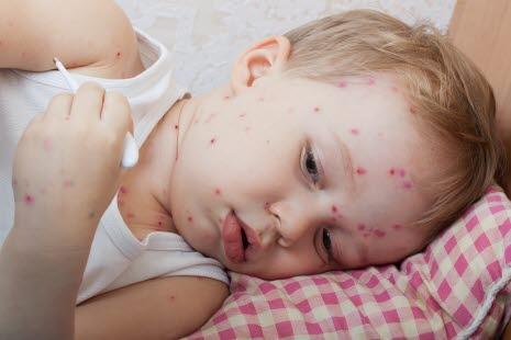 Chickenpox