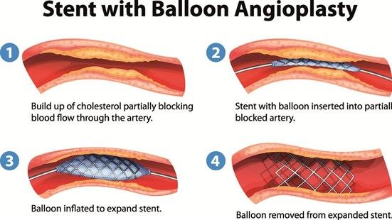Angioplastikk og stenting