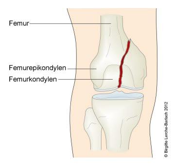 7322-2-fraktur-transkondyler-femoris.jpg 7322-2-fraktur-transkondyler-femoris.jpg